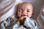 Dominic Pio Gundrum, Baby Born With Encephalocele And Tessier Facial ...
