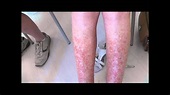 A very severe case of Sun Allergy (Polymorphic Light Eruption) before ...