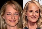 Helen Hunt's Plastic Surgery: See Her Face Before and After Photos