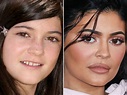 Kylie Jenner Before and After: From 2008 to 2022 - The Skincare Edit