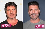 Simon Cowell Plastic Surgery Makeover Exposed By Top Docs