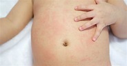 Rashes In Babies And Children: What's My Child's Rash? - Netmums