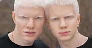 Brothers Bera and Tsotne Ivanishvili were born with albinism – now the ...