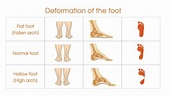 Podiatry and physio helps kid's flatfeet using insoles | PhysioActive ...