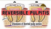 REVERSIBLE PULPITIS II INFLAMMATION OF PULP II DISEAES OF PULP II ...