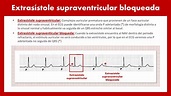 CardioTruco: extrasístoles supraventriculares - Cardioprimaria Ferrol