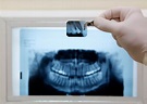 Rayos X Dentales | Aparato de Rayos X Dental | Conoce Más