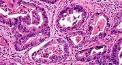 Pathology Outlines - Intestinal type adenocarcinoma