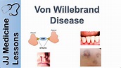 Von Willebrand Disease | Pathophysiology, Types, Symptoms and Treatment ...