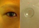 Girl, 11, cries blood-stained tears from contact lens stuck in eyelid ...
