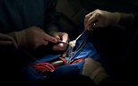 Open Heart Surgery Photos Stock Photos, Pictures & Royalty-Free Images ...