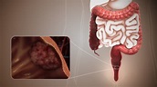 Colorectal cancer: Symptoms, Causes, and Treatment - Scientific Animations