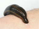 WATCH: See How Leeches Can Be A Surgeon's Sidekick | NCPR News