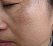 Mary Fong帶你了解更多有關荷爾蒙斑 - blog4hk 護膚心得