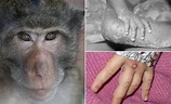 致死率可达10%！多国出现猴痘病例，如何防范？