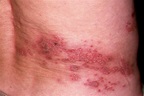 Herpes zoster (syn. shingles)