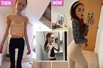Scots girl's hair fell out & weight plunged to just 4st in anorexia ...