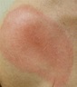 Deep Machine Learning Can More Accurately Identify Erythema Migrans ...