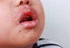 Hand, foot and mouth disease strikes Pittsburgh-area schools ...