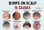 Bumps on the Scalp: 16 Causes, Pictures, and Treatment