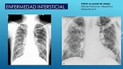 Enfermedad pulmonar intersticial difusa