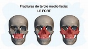 FRACTURAS LE FORT 💀 - YouTube