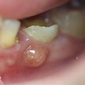 Tooth Abscess: 5 Stages, Symptoms, Pictures & Treatment (2023)