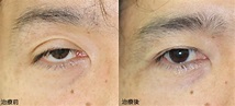 眼瞼下垂の症例写真 | 福岡早良区の形成外科・皮膚科・シミを取る医療レーザー治療は星の原クリニック