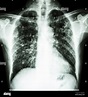 Film radiografía de tórax muestra infiltrado intersticial pulmonar ...