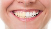 10 tips para mantener tus dientes blancos y sanos