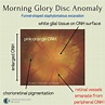 Morning Glory Disc Anomaly — Ophthalmology Review