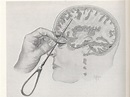 La lobotomía: taladrar el cerebro para "curar" enfermedades ...