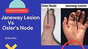 Janeway Lesions Vs Osler's Nodes (Simplified Approach) - YouTube