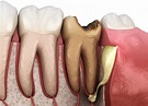 Can A Dental Abscess Become Dangerous?