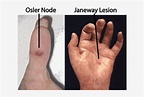 Janeway And Osler - Janeway Lesions And Osler's Nodes - 620x479 PNG ...