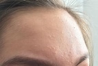 What Are These Tiny White Bumps On Your Face And How - vrogue.co