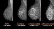 Breast Density: Does it really matter? – Life Among Women