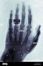 X-ray von Wilhelm Röntgen von Albert von Kölliker s Hand - 18960123-01 ...