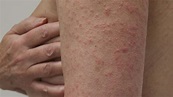 Allergien im Frühling: Das hilft gegen Immunreaktionen! - Gesundheit ...
