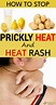 How To Stop Prickly Heat And Heat Rash - Remedies Lore