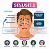 Sinusite chronique : causes, signes et traitements