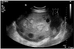 Krukenberg tumor in a pregnant patient with severe preeclampsia