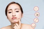 臉上斑點常見有4種 你是哪種？預防長斑是關鍵 | 種類 | 老人斑 | 雀斑 | 大紀元