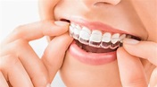 ¿Cómo funciona la ortodoncia con alineadores invisibles? - Estudi ...