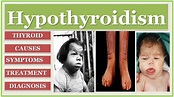 THYROID DISEASE | HYPOTHYROIDISM | CRETINISM | MYXOEDEMA | TREATMENT ...