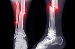What Is a Compound Fracture? - Fast Pace Health