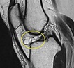 Hoffa fat pad ganglion cyst | Radiology Reference Article | Radiopaedia.org