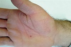 Intense itching on the palms | GPonline