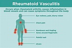 What Is Rheumatoid Vasculitis? Symptoms, Diagnosis, and Treatment