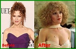 The Condition Of Bernadette Peters Breast Implant Surgery Before And ...